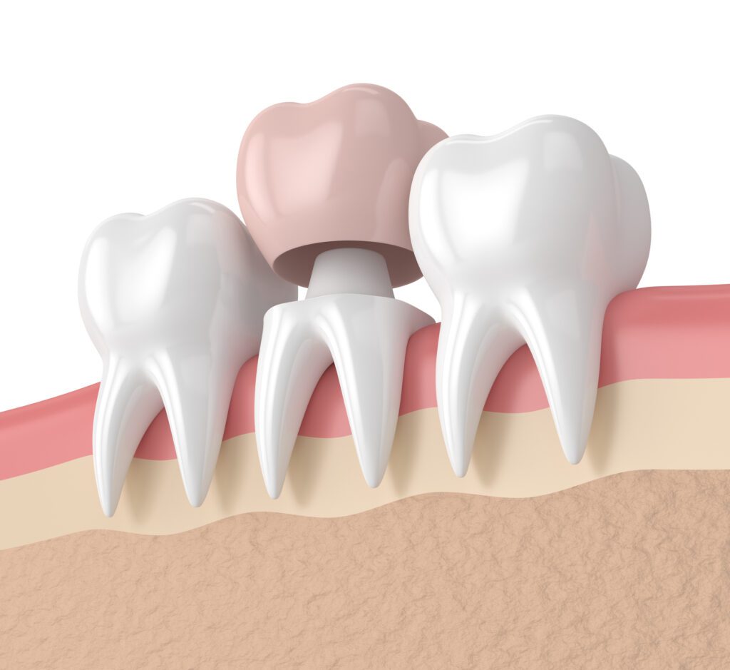 dental crown in Flint, TX