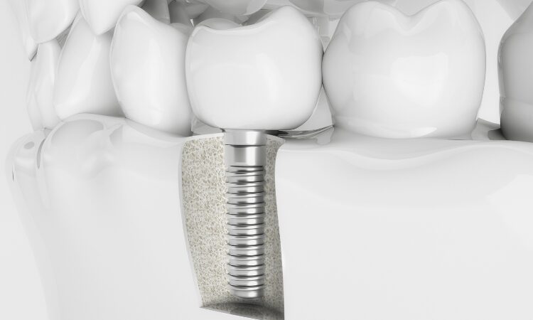 Restore Your Smile with Dental Implants